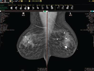 Challenge: Acquiring 3D Mammography Images Solution: ZFP Mammography Viewing Consolidated mammography viewing from any web-enabled viewer No viewer