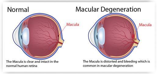 First GWAS Age related macular degeneration was the first positively associated disease which was found in 2005, using 96 Caucasian individuals with this disease and only 50 without.