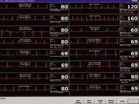 QRS complexes to allow you to measure beat-to-beat averages for a quick and easy review of QRS duration Clinical Review and Analysis Up to nine recorded waveforms of full disclosure together with