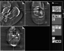 SIREMOBIL Iso-C 3D Delivering uncompromised safety in the OR A broad range of applications SIREMOBIL Iso-C 3D has been developed for intra-operative use in the radiographic imaging of the following