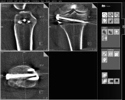 Post-operative SIREMOBIL Iso-C 3D Advanced user and patient comfort Sterile conditions With 190º of orbital rotation for 3D