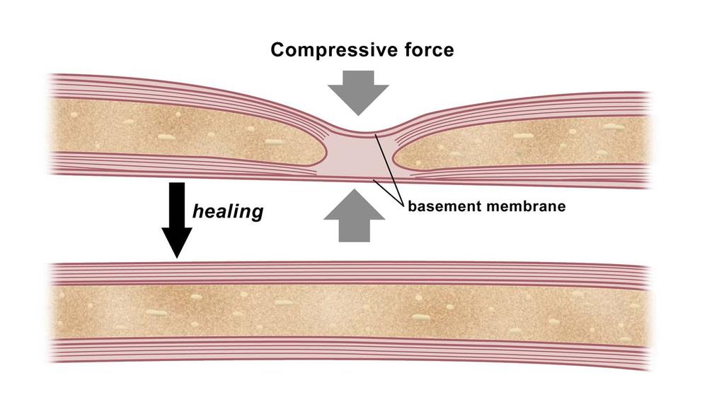 NERVE: The injured myelin sheath regenerates spontaneously Injured