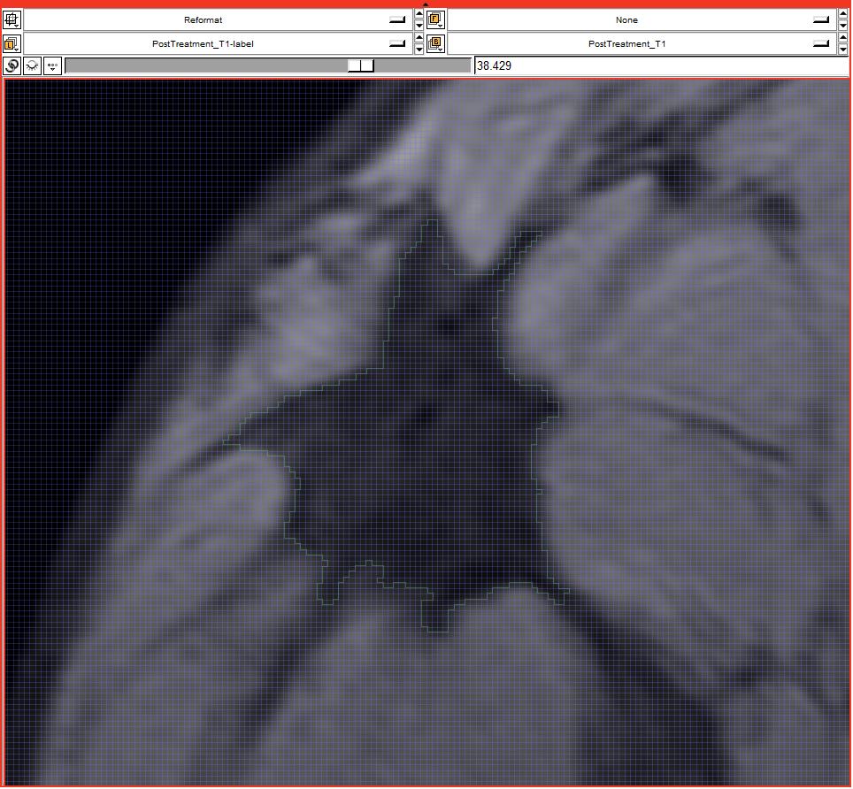 Volumetric MRI Analysis using 3D Slicer: ROI Comparison Volumetric Analysis using 3D Slicer: ROI Comparison Pre- and