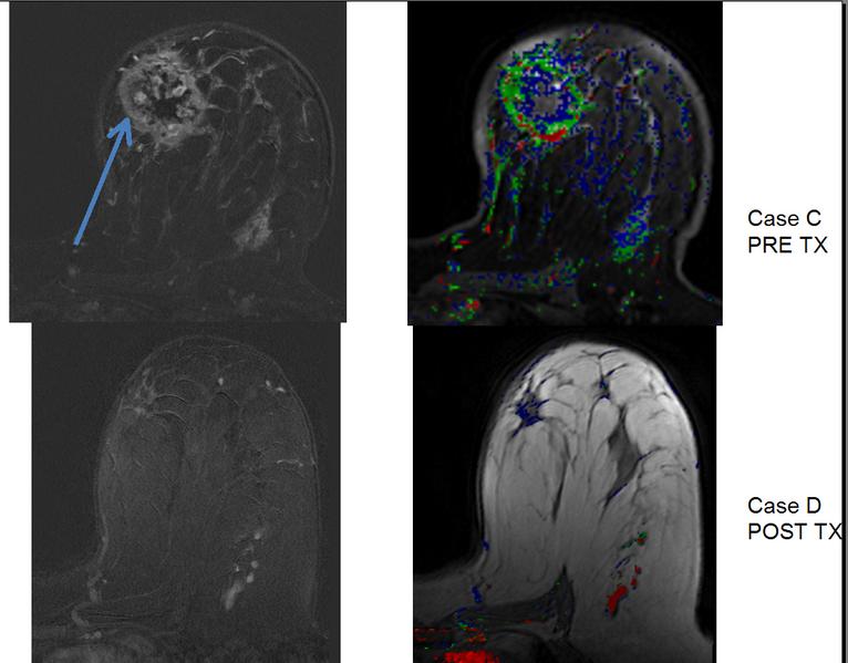 DCE-MRI Example Images from 3D Slicer Demo Slide