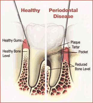 Production of organic acids results in destruction of protecting dental enamel (Decalcification) Formation of deep pockets