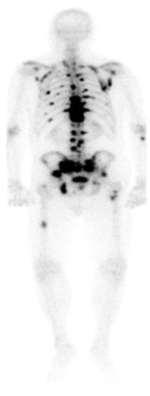 BONE SCINTIGRAPHY with
