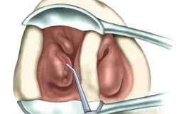 THE UNIVERSAL LASER FOR TREATMENTS IN ORL 5 Laser-Turbinoplasty inside the nasal cavity to reduce the inferior