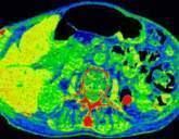 Spectral Imaging- Clinical benefits Quantitative CT characterize the chemical compositions such as kidney stones Characterize small lesions help characterize
