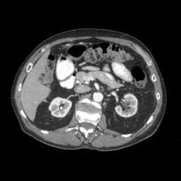 Spectral Imaging Improved Visualization Left Kidney Stone Clinical Value Evaluate for kidney