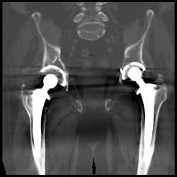 Metal Artifact Reduction Bilateral Hip