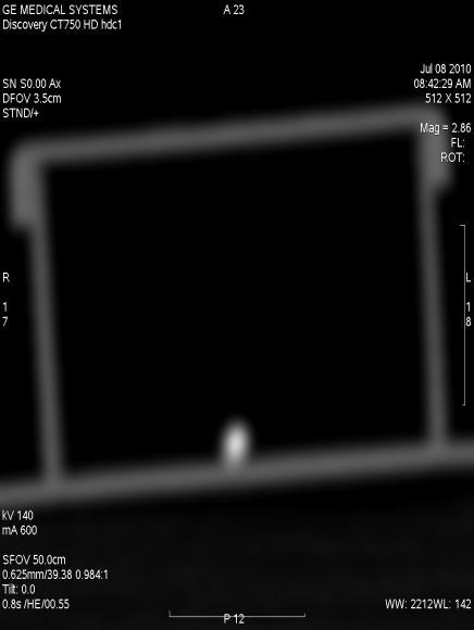 Spectral Imaging Material Quantification Unusual example of quantifying renal calculi Renal