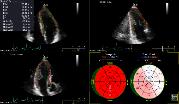 Heart Model, Anatomical Intelligence TOMTEC strengthens image processing, quantification and reporting Accelerating in