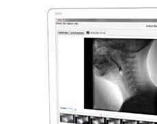 Endoscopic and video-fluoroscopic methods for the diagnosis of dysphagia complement each other perfectly.