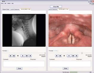 The evaluation is processed by means of the video-fluoroscopy protocol and is handled by the DiVAS software.