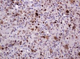Human lymphoma tissue using anti-pcna mouse monoclonal antibody.