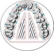 Do not attach bars in interdental areas. Connect all pontics, to which a bar has been attached, to the sintering frame.
