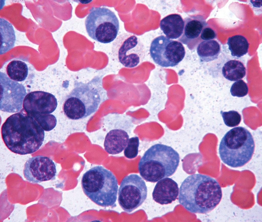 C and D, Focal bone marrow involvement and plasma cells with prominent nucleoli (C, H&E, 400; D, Wright-Giemsa, 1,000).