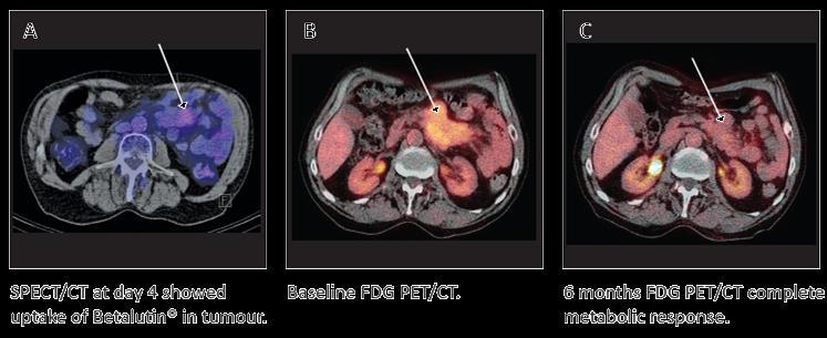 CT: fluorodeoxyglucose positron emission tomography-computer tomography; FL: follicular