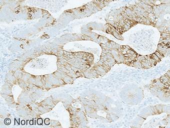 3b Insufficient CK20 staining of the colon adenocarcinoma using the same protocol as in Figs.