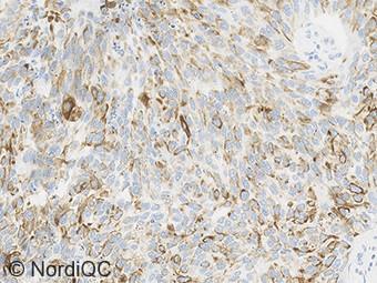 The staining intensity and proportion of neoplastic cells is significantly reduced compared to the level expected