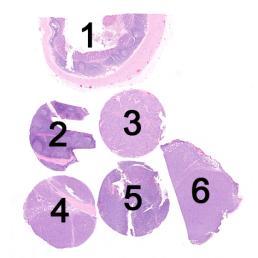 Assessment Run 36 202 CD38 Material The slide to be stained for CD38 comprised:. Appendix, 2. Tonsil, 3. Ovarian serous carcinoma, 4. Plasmacytoma, 5. & 6. Diffuse large B-cell lymphoma (DLBCL).