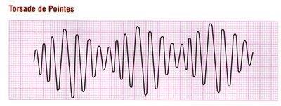 Torsades de Points (TdP) TdP is a specific type of abnormal heart rhythm that can lead to sudden cardiac death.