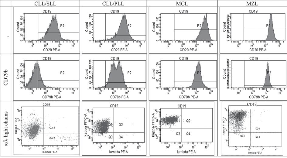 Proposals of B cells standard immunophenotyping in mature B cell non-hodgkin lymphomas κ/λ light chains CD79b CD20 Fig. 1.