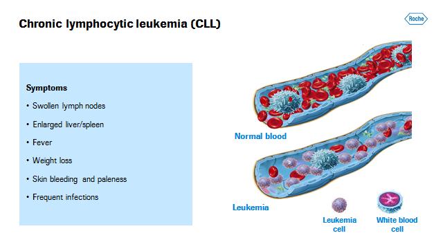 Address by Severin Schwan page 8/11 Chronic lymphocytic leukemia (CLL) is one of the most common types of blood cancer, typically affecting older people.