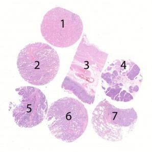 Assessment Run 40 2014 Cytokeratin 7 (CK7) Material The slide to be stained for CK7 comprised: 1. Kidney, 2. Lung, 3. Gastric corpus, 4. Pancreas, 5. Colon adenocarcinoma, 6-7.