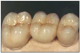Dental Ceramics Excellent aesthetics (opaqueness & color) Very tough and hard material But brittle; improvements of