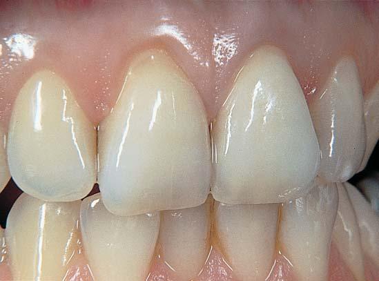 In the case of VITA In-Ceram 2000 YZ the upper material sample was shaded with VITA COLORING LIQUID. optimum aesthetics and excellent biocompatibility, i.e. no exposed metal margin good light transmission properties no retraction of the gingiva accurate marginal fit (Fig.