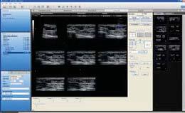 SonoAVC Sonography-based Automated Volume Count SonoNT Sonography-based