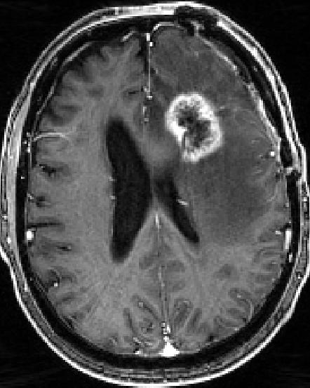 Avastin in Refractory Glioblastoma Multiforme (GBM) High unmet medical need Lesion Screening Week 12 Week 24 Incident Primary Brain Tumors population in line with mrcc 20,000 incident patients in top