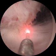 Contrary to mechanical and electro-hydraulic systems the Sphinx Holmium laser does not apply external kinetic force, thus preventing the calculi from being pushed further inside the ureter.