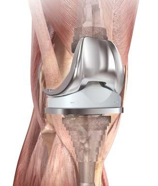 Knee Revision Solutions Strengthen leadership in high growth segment Function with wear resistance