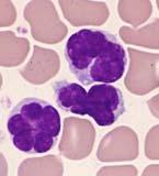 Adult T cell leukemia A rare cancer of the immune system s own T cells Human T cell