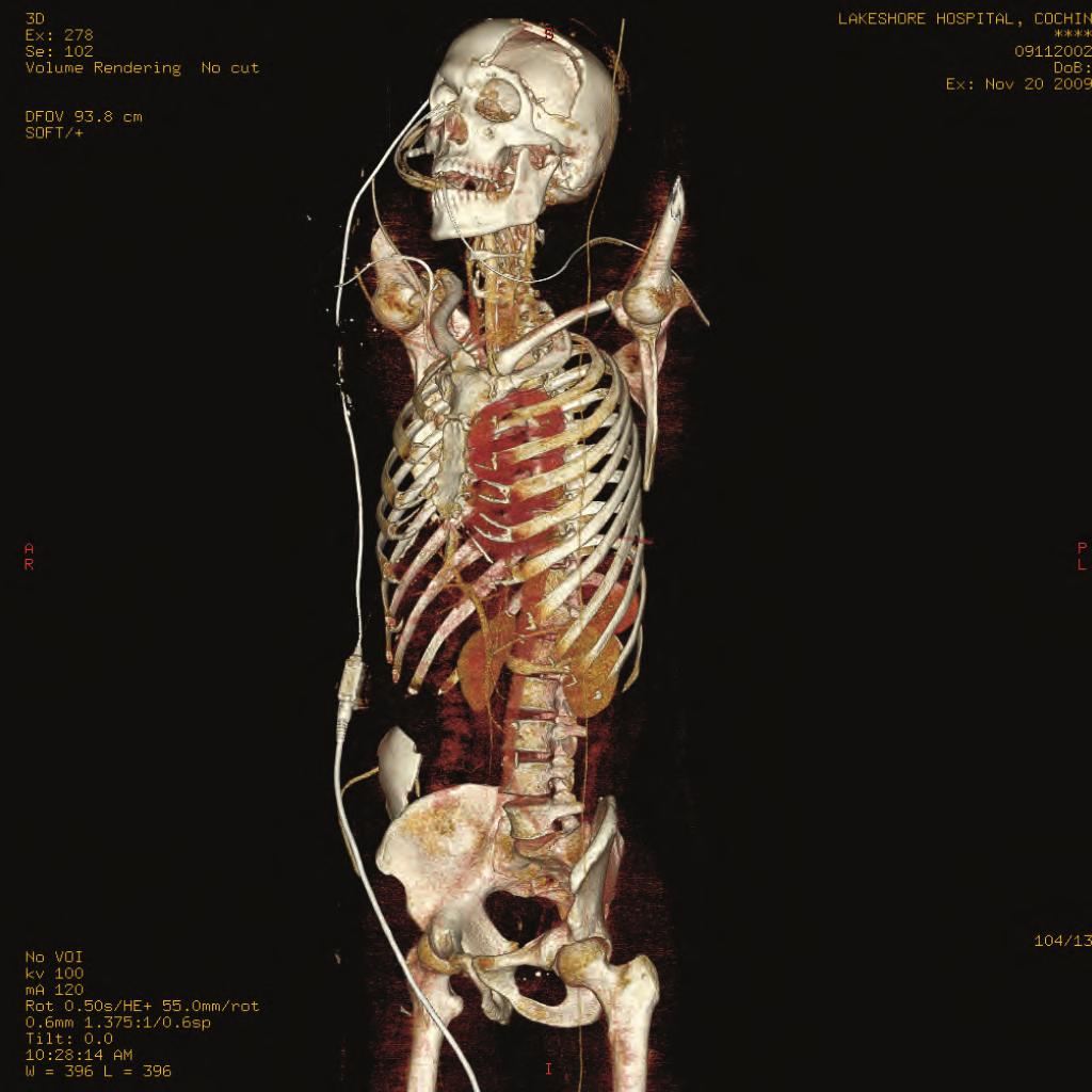 Whole body scan, poly trauma application A single CT whole body trauma evaluation is one of the most powerful tools for managing patients with multiple critical injuries.