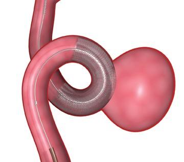 Diverting Stents Emerging Treatment for Intracranial Aneurysms