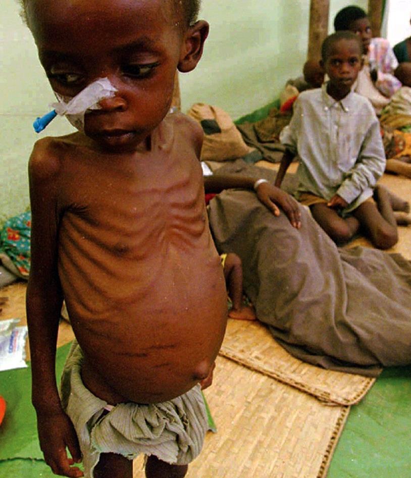 World hunger and malnutrition are decreasing, but they are still unacceptably high.