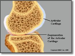 The Problem: Current Cartilage Implant Failures Bone