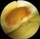 cartilage defect LaPrade R, Konowalchuk B, Fritts H,
