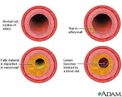 artery diseases (hardening of the arteries) Affects approximately 58