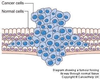 CANCER What is cancer? Uncontrolled cell division. Cancer is essentially a disease of mitosis. Why?