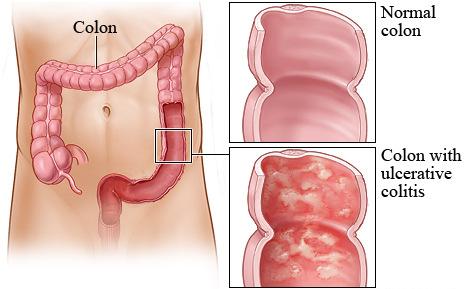 Both ulcerative colitis and Crohn's disease usually run a waxing and waning course in the intensity and severity illness. When there is severe inflammation, the disease is considered to be in an Fig.