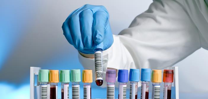 Why blood sample Blood sample is the