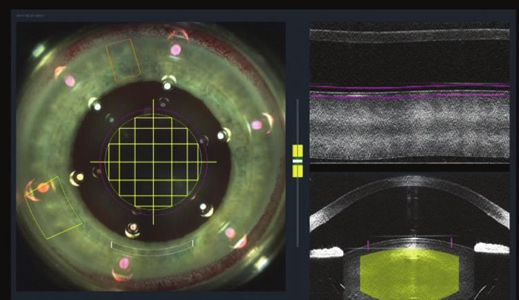 (Courtesy of John Davidson, MD.) Figure 1. The LenSx Laser s software is designed to optimize precision in making arcuate incisions, the capsulorhexis, and fragmenting cataractous lenses. Dr.