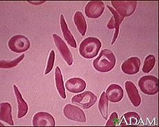 Natural selection: Sickle Cell Anemia Sickle cell anemia is a disease in which your body produces abnormally shaped red blood cells.