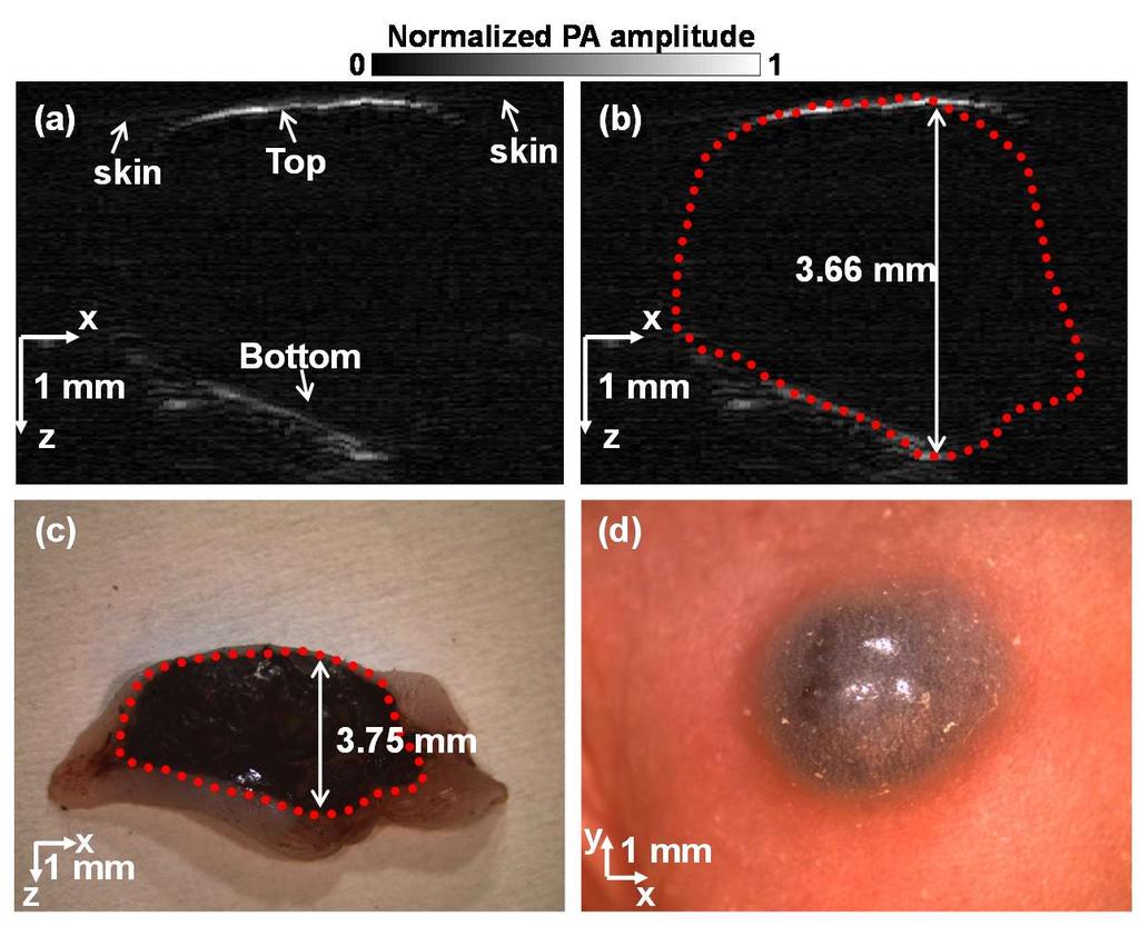 Figure 6.5 Handheld PAM of melanoma in a nude mouse in vivo. (a) PAM image of the melanoma clearly showing both the top and bottom boundaries.