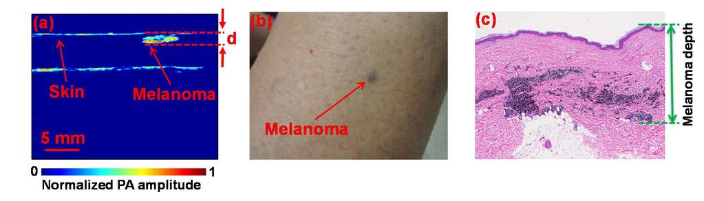 study were explained to the patients in detail. A written consent was obtained for the procedure. For each patient, we first imaged the melanoma with our PAT probe.
