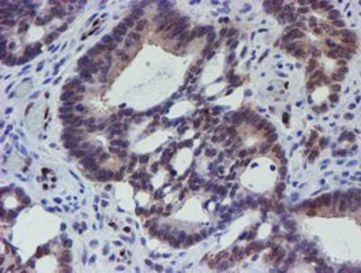 Staining of paraffin-embedded Adenocarcinoma of Human colon tissue using anti-elk3